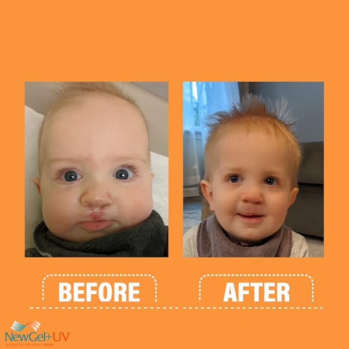 NewGel+UV Advanced Silicone Scar Gel for OLD and NEW Scars with SPF30 Mineral Sunscreen, Ideal for Facial Scars Exposed to Sun. 15g (0.5 oz)