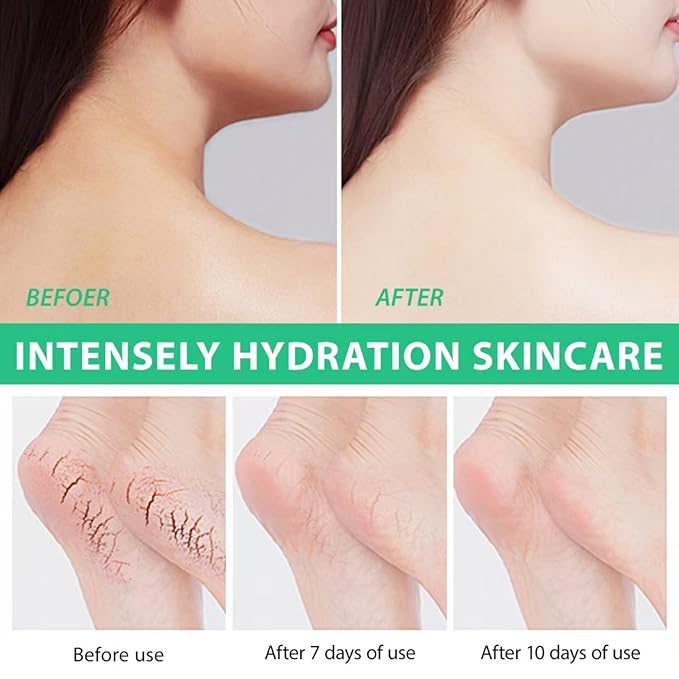 Urea Cream 40 Percent, 40% Urea Cream Plus 2% Salicylic Acid for Feet Maximum Strength, Deeply Moisturize, Repair Dry, Cracked, Rough Skin of Heel, Elbow and Knee, Foot Cream and Hand Cream