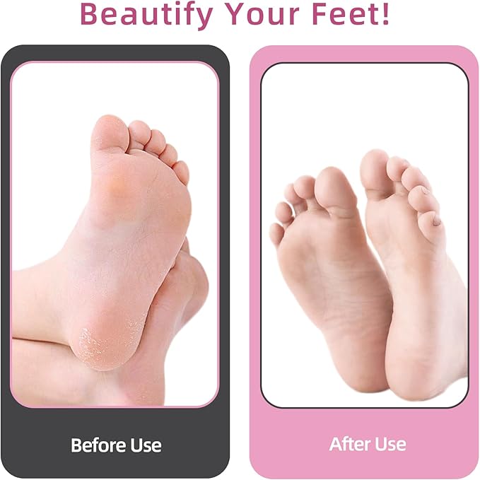 4.8IN Longer Electric Foot Callus Remover with 80pcs Sandpaper Discs, Professional Aluminum Callus Remover for Feet, Stepless Speed Control Pedicure Tools for Dead Skin (Pink)