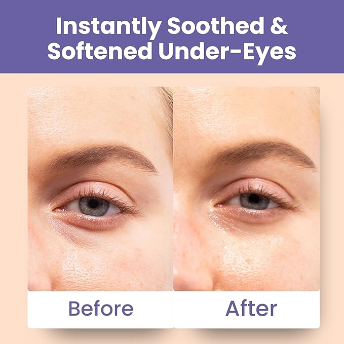 Patchology Skin Remedy Soothing Eye Gels – Ultra-Soft Hydrogel Undereye Masks with Ectoin, Ceramides & Botanical Blend – Hydrate, Revive & Refresh Puffy & Tired Eyes – For All Skin Types (5 Pack)