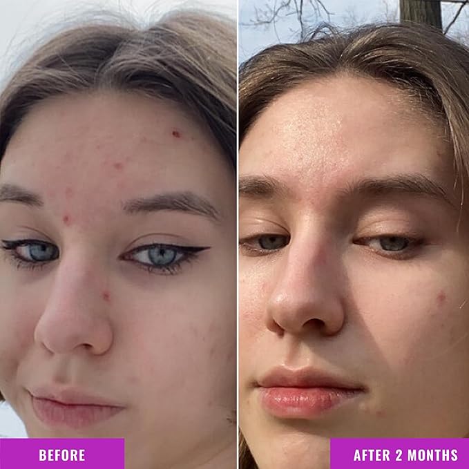 Good Molecules Niacinamide Serum - 10% Niacinamide B3 Facial Serum for Blemishes, Enlarged Pores, Balancing and Hydrating - Skincare for Face