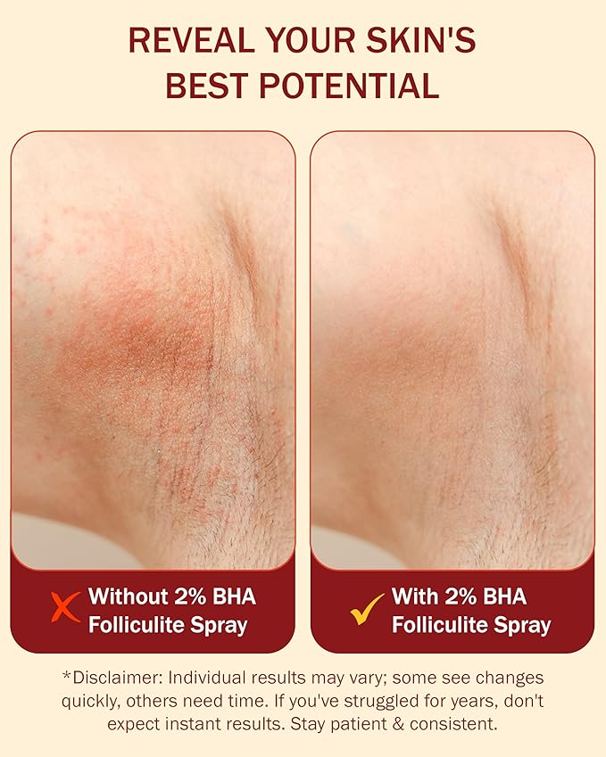 2% BHA Folliculitis Body Oil Spray - Salicylic Acid Body Mist with Tea Tree Oil & Aloe Vera - Spray Moisturizer for Dry Skin, Clogged Pores & Irritation, 4 fl. oz