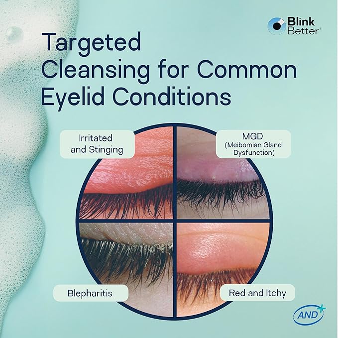 BlinkBetter BetterLids Eyelid Foam Cleanser – Tea Tree Oil Face & Eyelid Wash with Ectoin, Centella, Beta Glucan & Panthenol – 4-in-1 Hydrating, Soothing, Purifying Formula – 2 oz- Preservative Free