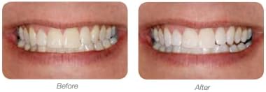 LumiSmile White Take-Home Teeth Whitening Treatment Syringes; Two (2) 2.5 ml Syringes of 16% Carbamide Peroxide Whitening Treatment