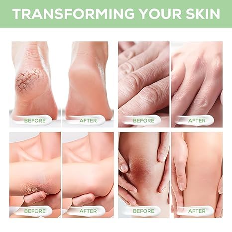 Urea Cream 40 Percent Plus 2% Salicylic Acid, 40% Urea Cream Suitable for Rough and Cracked Skin on Heels Ankles and Knees Deeply Moisturize Exfoliate Soften and Loosen Dry Callused Skin-4.23 Oz(120g)