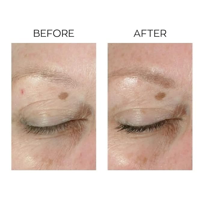 Anew lifting dual eye system