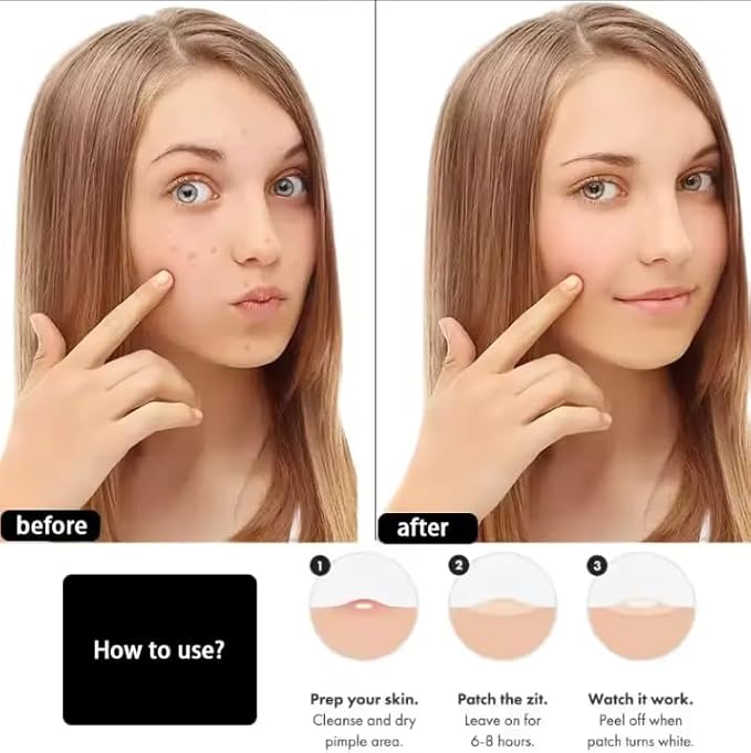 Hydrocolloid Acne Patch Stickers – Overnight Blemish & Cystic Acne Treatment with Tea Tree Oil | Invisible Skin Spot Care Patches (Pack size)