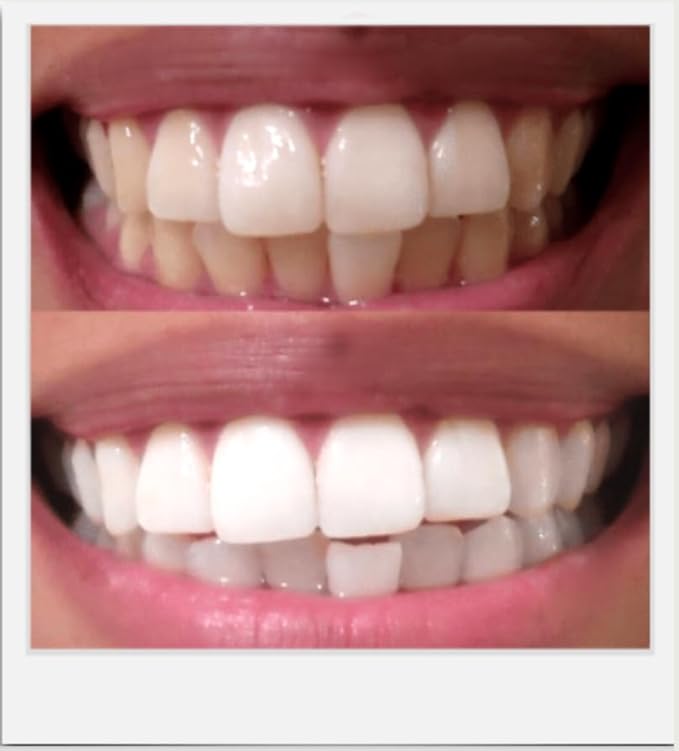 Teeth Whitening Gel Refills (6-gels). Made USA. 44 percent Carbamide Peroxide Tooth Bleaching Gel bleach For Invisalign style trays, Dental Grade Tooth Whitener. 6 syringes