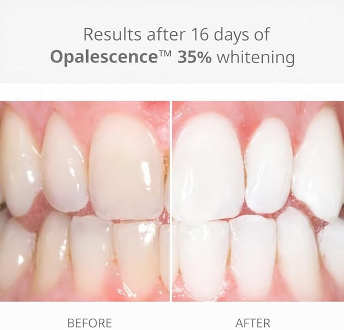 Opalescence 35% with PF Gel Syringes Teeth Whitening - (8 Syringes) Refill Kit Carbamide Peroxide. Made by Ultradent, in Melon Flavor. Tooth Whitening Refill Syringes 5404-4