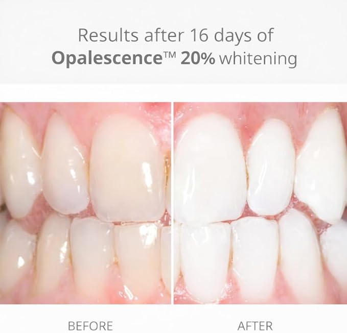 Opalescence 20% with PF Gel Syringes Teeth Whitening - Refill Kit (12 Syringes) Carbamide Peroxide. Made by Ultradent, in Melon Flavor. Tooth Whitening 5401-6