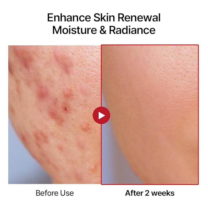 Swanicoco PDRN 2% Hydrating Repair Ampoule Serum, Salmon DNA 20,000 ppm 2% Powerful Anti Aging Face and Neck for Skin Turnover Skin Regeneration Wound Healing Korean Skincare 30ml 1Fl Oz