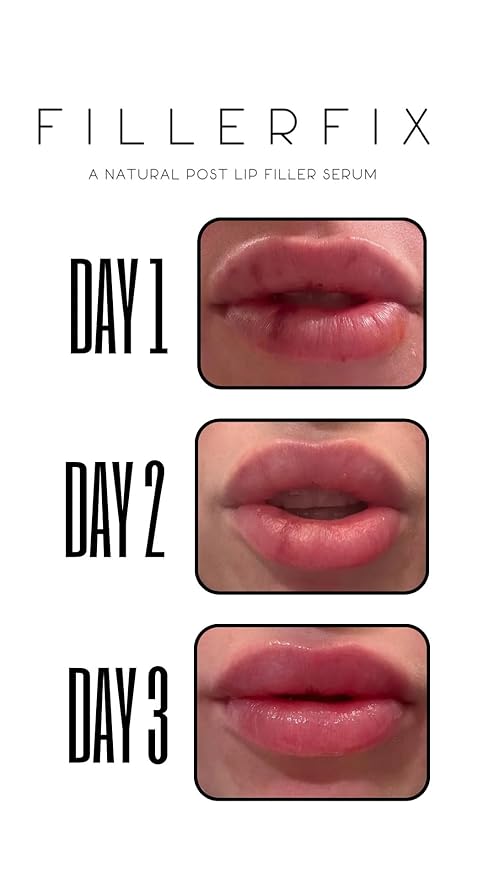 FillerFix Organic Lip Filler Aftercare Serum with Cooling Ceramic Tip – Arnica & Calendula for Relief After Lip Filler