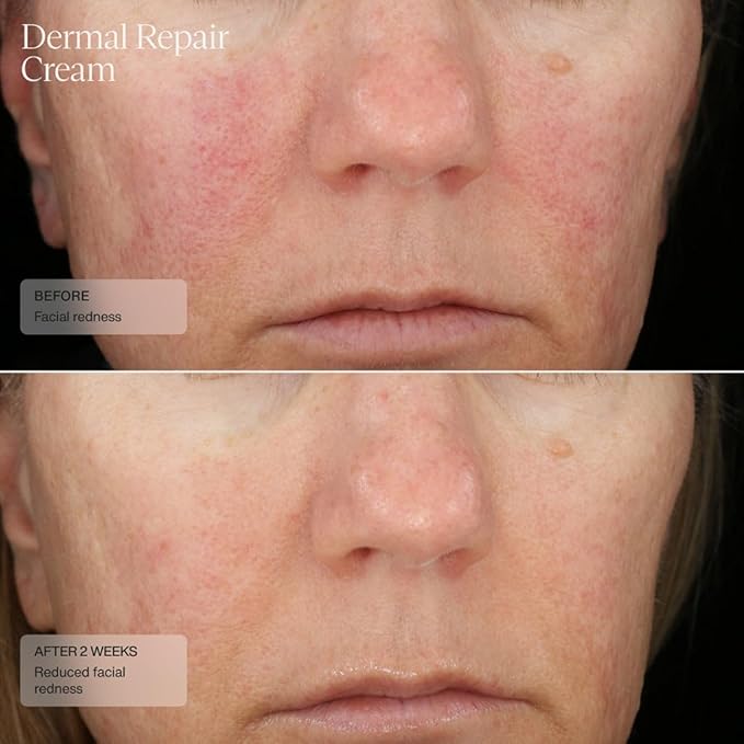 Senté Dermal Repair Facial Cream | Nourishing for Rosacea, Sensitive Skin, & Post-Procedure | Hydrate & Soothe| with Patented HSA, Vitamin E & Green Tea Extract | 1.7 Fl Oz