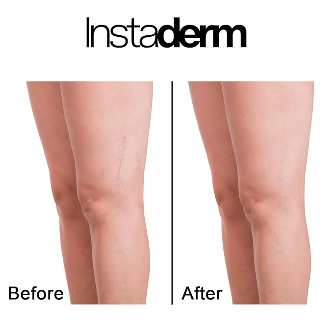 Instaderm Vitamin K Cream- Bruise Healing Formula with Arnica. Dark Spot Moisturizer for Bruising, Spider Veins & Broken Capillaries. Repair Under Eye Dark Circles, & Puffiness.