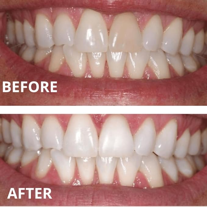 Teeth Whitening Gel Refills (6-gels). Made USA. 44 percent Carbamide Peroxide Tooth Bleaching Gel bleach For Invisalign style trays, Dental Grade Tooth Whitener. 6 syringes