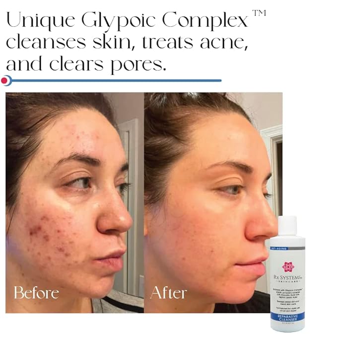 Rx Systems PF Reparative Facial Cleanser 8 oz, Repairs Skin, Clears away Oil and Dirt Build Up, Prevents Acne and Clogged Pores