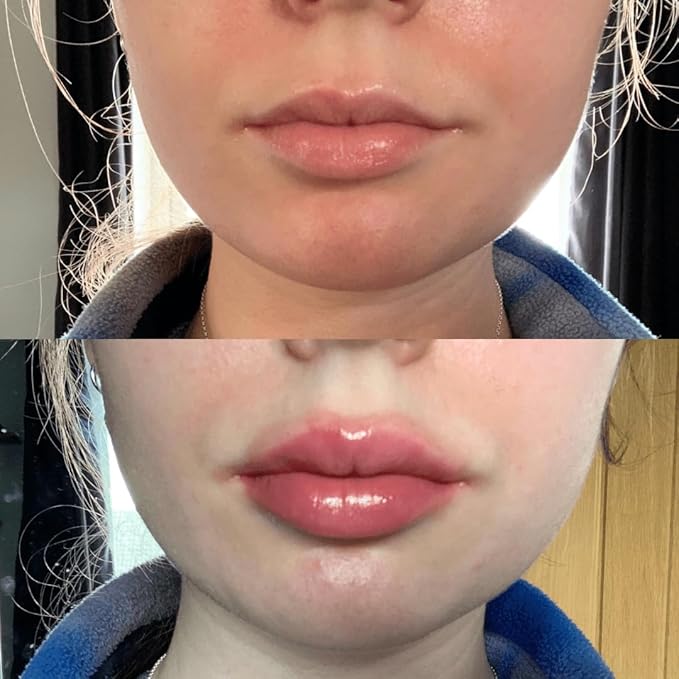 Plump It! No Needles Lip Filler Plumping
