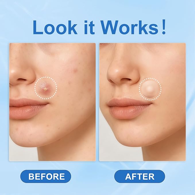 Amouy Acne Pimple Patch- 2 Sizes 612 Dots Thin & Thick Hydrocolloid Patches for Face with Witch Hazel, Tea Tree & Calendula Oil, Extra Adhesion Pimple Patches for Face Zit Patch Acne Dots