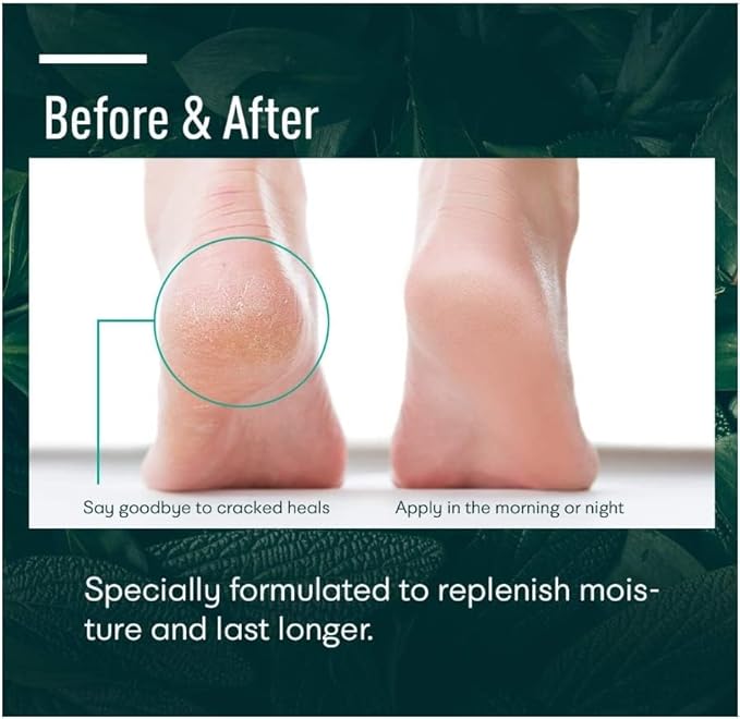 Urea cream 40 perent for feet: Maximum Strength Urea lotion -For Callus and Cracked Heels Treatment-Rough Thick Skin for foot- Crema 5.29 oz.(150g)