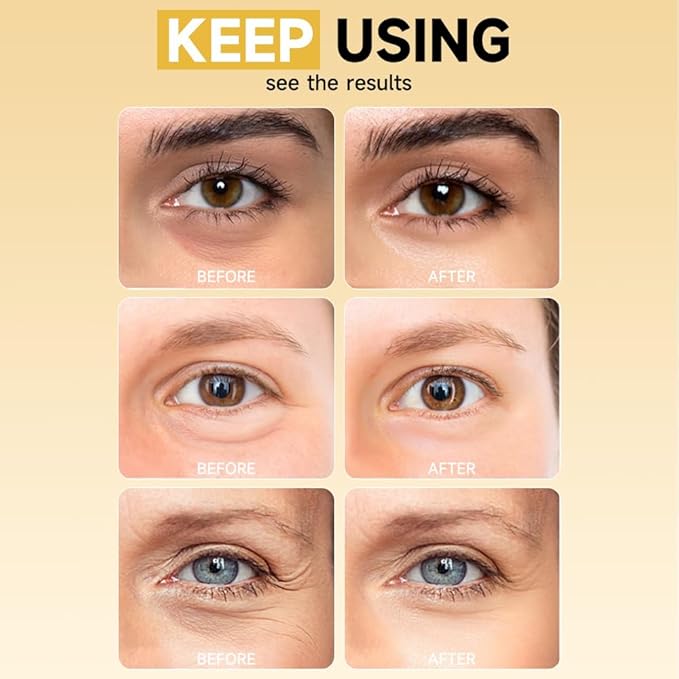 8 Pairs 5% PDRN Under Eye Patches, 6-in-1 Bio-Collagen 360° Eye Patches for puffy eyes, dark circles & Wrinkle | 2% Caffeine, Kojic acid, Retinol, Hyaluronic, Niacinamide | Korean Popular Eye Care