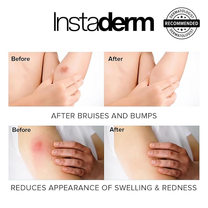 Instaderm Vitamin K Cream- Bruise Healing Formula with Arnica. Dark Spot Moisturizer for Bruising, Spider Veins & Broken Capillaries. Repair Under Eye Dark Circles, & Puffiness.