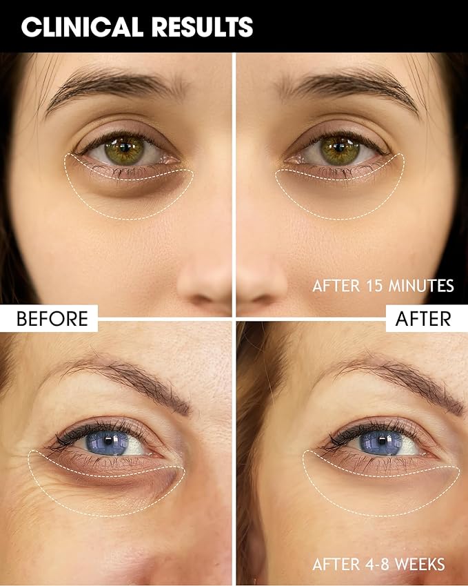 TTLALA Eye Cream with 6% High-purity Caffeine & 1% Bakuchiol, Under Eye Cream for Dark Circles, Puffiness, Fine Lines, Anti Aging, Wrinkles, Eye Bags Treatment for Women & Men with 360° Roller, 0.57oz