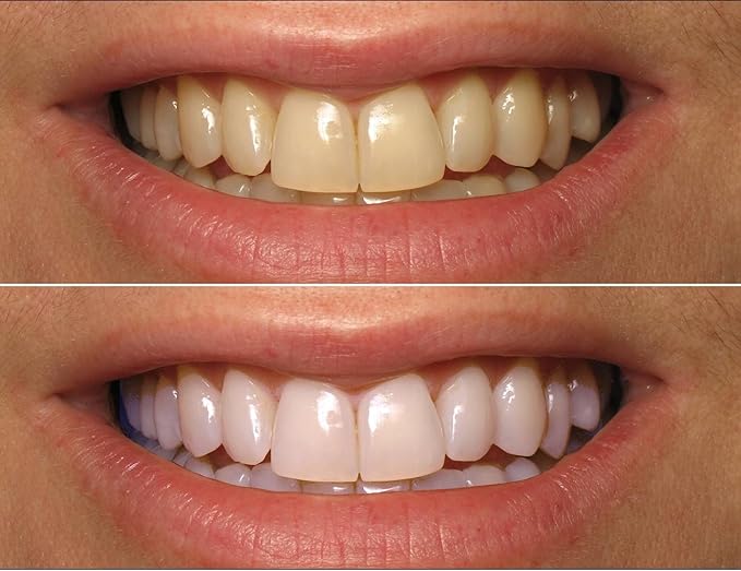 ProDental Teeth Whitening Gel Syringe Refill 10 Pack, 35% Carbamide Peroxide - 60 Treatments, Faster Results Than Tooth Whitening Strips - Pen - Powders and Toothpaste, Safe for Sensitive Teeth