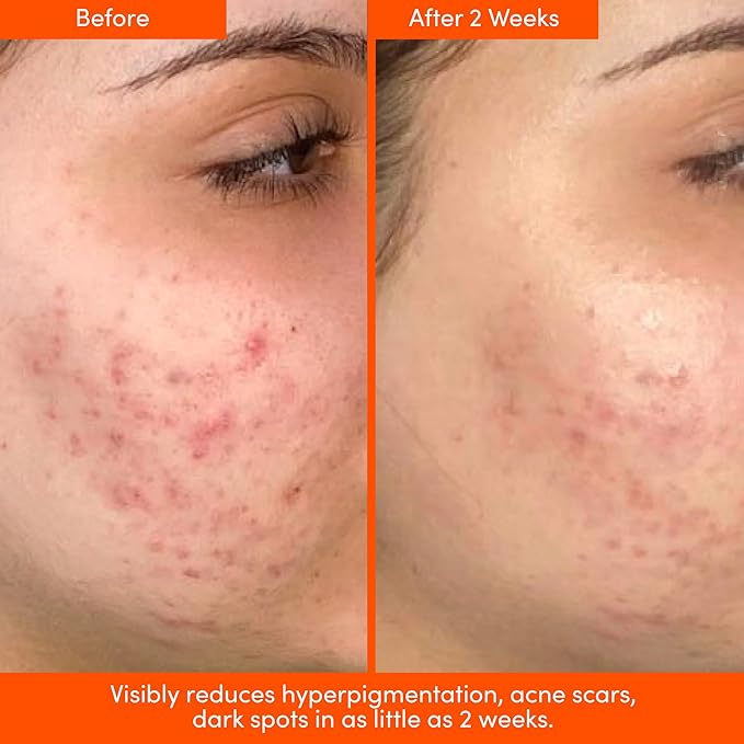 UNSPOTTED 4X Dark Spot Correction Serum for Face and Body, Exfoliating AHA Serum, Hydrating Formula With Azelaic, Glycolic, Lactic & Tranexamic Acids, Age & Sun Spot Remover, 1oz