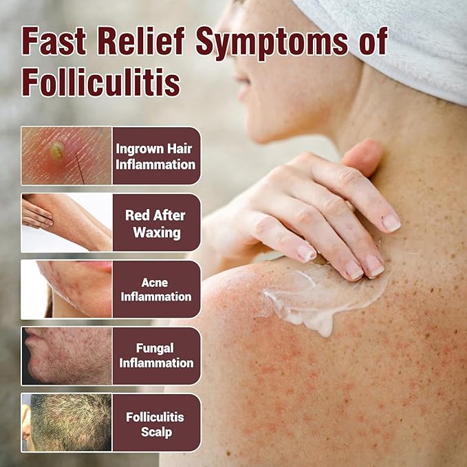 Folliculitis Treatment Cream, Fast-Acting Relief for Scalp, Face & Body, Soothes Itching, Redness & Inflammation, Natural Colloidal Oatmeal Formula for Sensitive Skin - 3.52oz