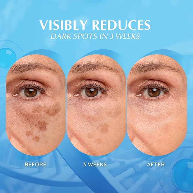 EnaSkin Dark Spot Remover for Face: Hyperpigmentation Body Treatment for Freckles Melasma Age Spot Sun Spot - Dark Spots Corrector Serum for Women and Men (2.0 Fl Oz)