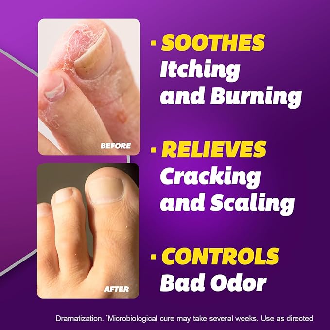 Silka Antifungal Cream, Clinical Anti-Fungus Foot Treatment, Results in 1 Week, Maximum Strength Athlete’s Foot Treatment, Jock Itch, Ringworm Treatment for Humans, Terbinafine Cream, 1oz- 2 Pack