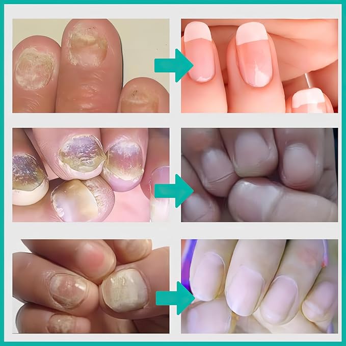 MIELIKKI Nail Repair Cream, Nail
