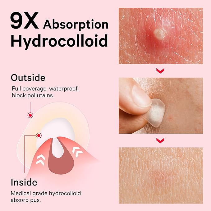 Sosky Pimple Patches for Face, Hydrocolloid Acne Patches with Salicylic Acid, Zit Stickers, Blemish Covers, 24 Count Invisible