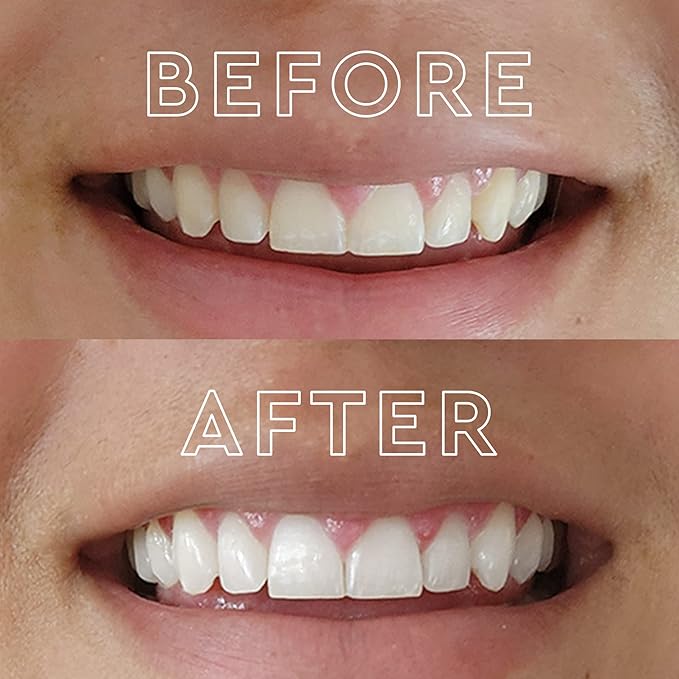 MOON Teeth Whitening Kit, LED Light Teeth Whitener Device, 56 White Strips, USB Charger & Travel Case, Blue Light Whitening Tray Removes Stains & Whitens Up to 12 Shades in 2 Weeks (4 Piece Kit)