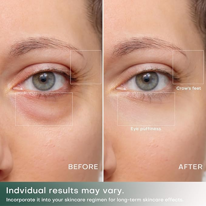 RF Radio Frequency Eye Device | 2 in 1 Eye Anti Aging Device | Under Eye Bags Treatment | Eye Bags | Eye Puffiness | Fine Line | Wrinkle Reducing - Professional RF Eye Skin Care Beauty Device