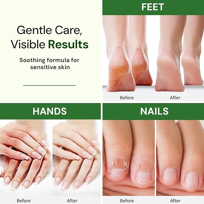 Natural Foot, Nail & Hand Cream - Skin Care & Nourishing Formula – Rich Hydration with Tea Tree - Daily Repair Cream for Men & Women, Softens, Protects & Restores Skin – 8oz
