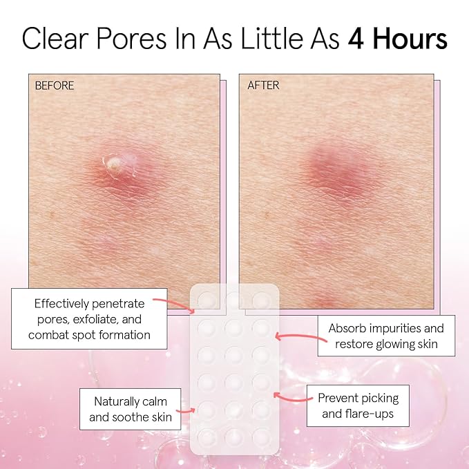 grace & stella Award Winning Pimple Patches for Face - Dermatologist Tested Acne Patches - Hydrocolloid Patch for Breakouts, Whiteheads - Vegan Acne Spot Treatment for Face (Invisible, 144 Count)