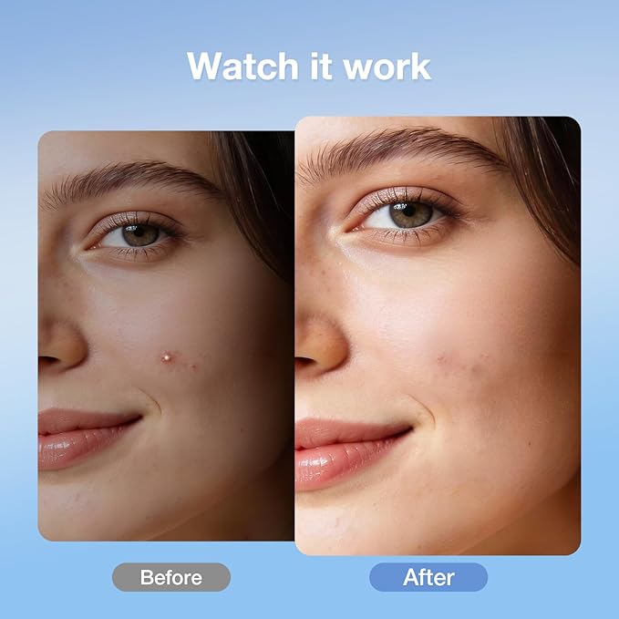 Invisible Daytime Pimple Patch–Ultra-Thin 0.2 mm Matte Hydrocolloid Acne Patch for Face, Makeup-Friendly with Waterproof Film, Clean-Care Complex, Patented Easy-Peel Design, 36 Count (Daytime)