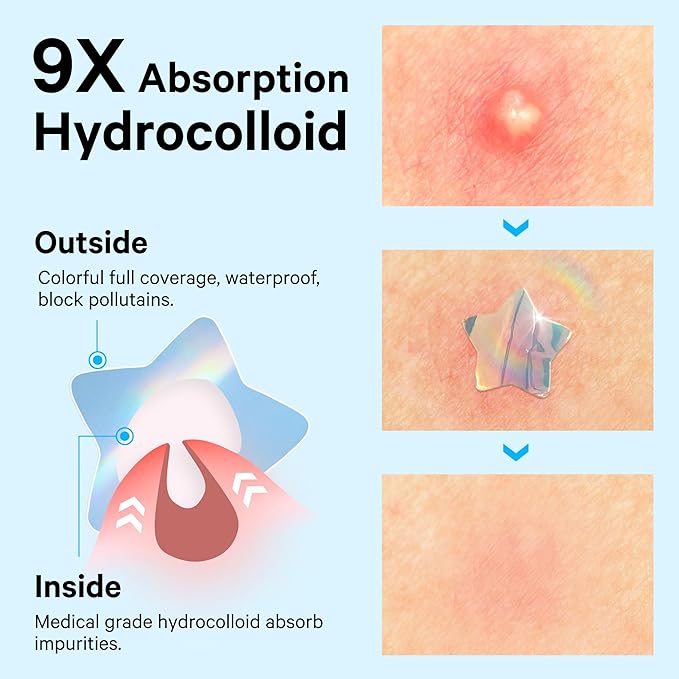 Sosky Hologram Pimple Patches for Face, Hydrocolloid Acne Patches with Salicylic Acid, Cute Star Zit Stickers,Colorful Blemish Covers,48 Count Blue Butterfly