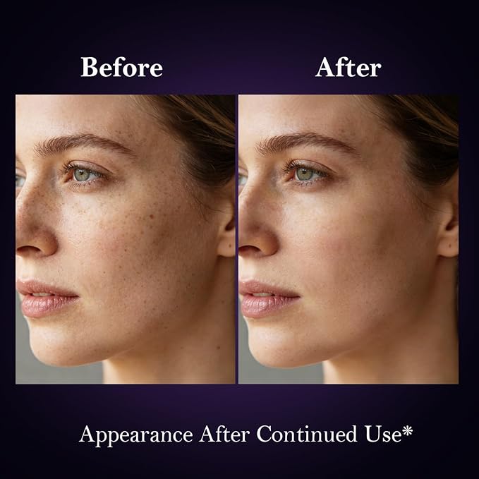 Dark Spot Remover for Face and Body, Dark Spot Correcting Glow Serum for Hyperpigmentation Treatment, Melasma, Sun Spots & Age Spots, Brightening Dark Spot Corrector Serum to Even Skin Tone, 1 fl. oz
