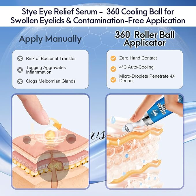 Stye Eye Treatment, Eye Serum for Stye, Chalazions & Blepharitis Roller Serum, Natural and Plant-based Formula (1 Fl Oz)