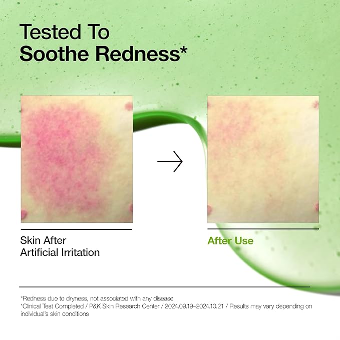 Anua Azelaic Acid 10 Hyaluron Redness Soothing Serum, Facial Serum for Blemish-Prone & Sensitive Skin, Lightweight & Hydrating Blemish Care, Hyaluronic Acid, Korean Skincare, 1.01 fl oz.