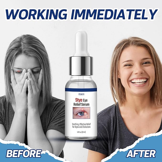 Stye Eye Treatment, Chalazion Treatment Serum, Stye & Blepharitis Remover with Hippophae Rhamnoides Fruit, Helichrysum Angustifolium Flower & Persea Gratissima Oil ((1 Fl. OZ (Pack of 1)))