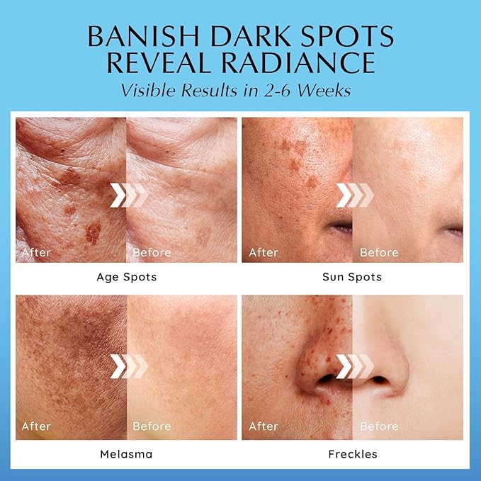 EnaSkin Dark Spot Remover Set – Serum & Cream Bundle (2-Step Brightening System) Dark Spot & Uneven Tone Care for Face & Body – For Women & Men