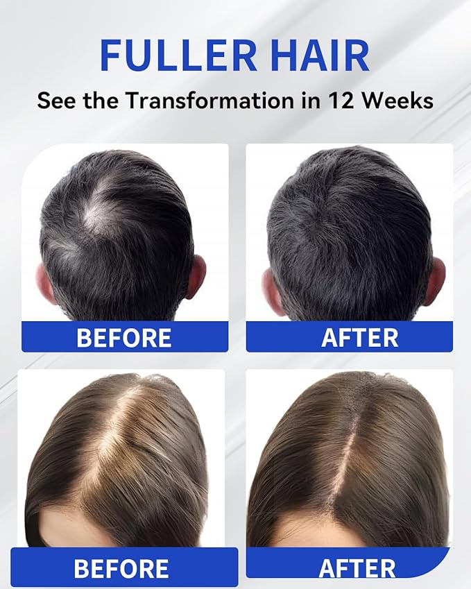 Hair Growth Serum Roll On 50ml | Hair Growth Serum 3% Rosemary Extract + Caffeine + Niacinamide + Biotin | With Ginger & Aloe Vera | No-Rinse, Fast-Absorbing | For Thinning Hair & All Hair Types