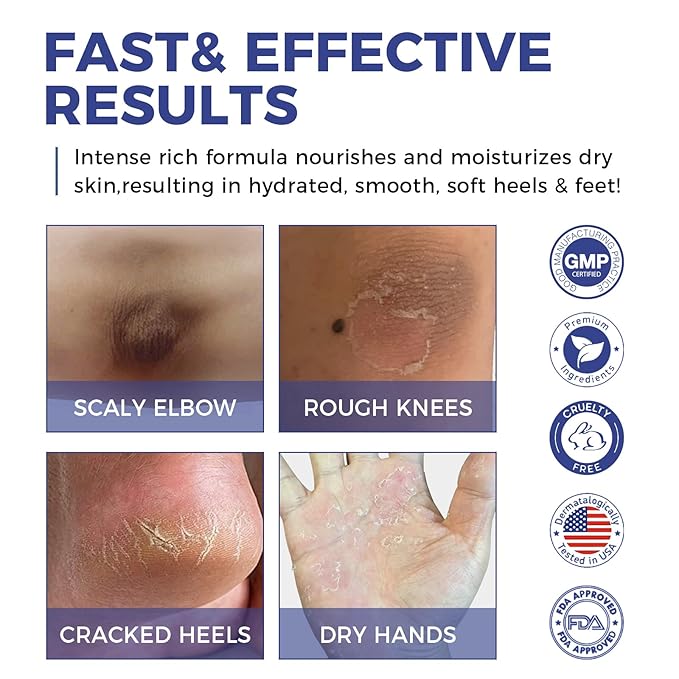 OUKEYA Urea Cream 42% Plus 2% Salicylic Acid, For Extremely Dry Skin on Heels, Elbows, Knees, 5.29 Ounce (Pack of 2)