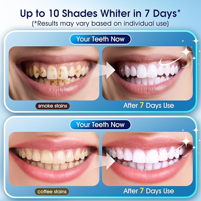 Teeth Whitening Kit – 3 Teeth Whitening Pens + 2 Desensitizing Pens – LED Light – 35% Carbamide Peroxide – Safe & Dentist-Recommended – Fast 7-Day Visible Whitening + Remineralizing Care(Orange)