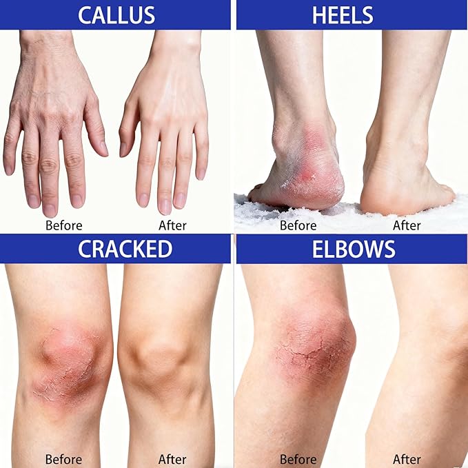 Urea Cream 40 Percent for Feet Maximum Strength, Urea Cream 40% Plus Salicylic Acid 2% for Rough, Dry, Thick & Cracked Skin, Deep Hydration, Non-Greasy, 5.29 Oz