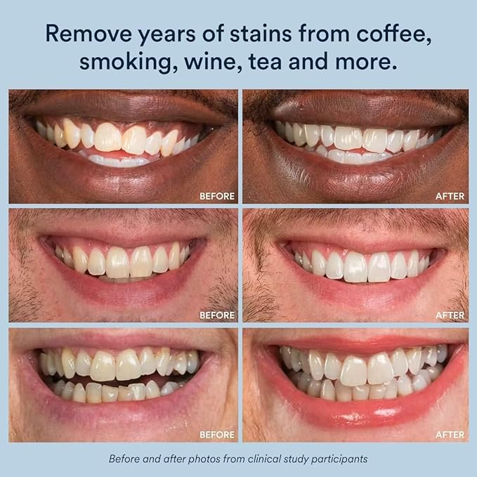 Auraglow Teeth Whitening Strips, Peroxide Free, 14 Treatments, Whitens Teeth Without Sensitivity, Natural Whitening Strips, Removes Years of Stains, Enamel Safe Teeth Whitener, 28 Strips, Mint