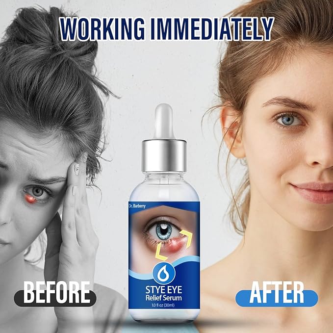 Stye Eye Drops, Stye Eye Treatment, Eye Stye Relief Serum, Non-Irritating Formula with Hippophae Rhamnoides Fruit Oil & Avo-cado Oil, Target Chalazions & Blepharitis (1 Fl. OZ)